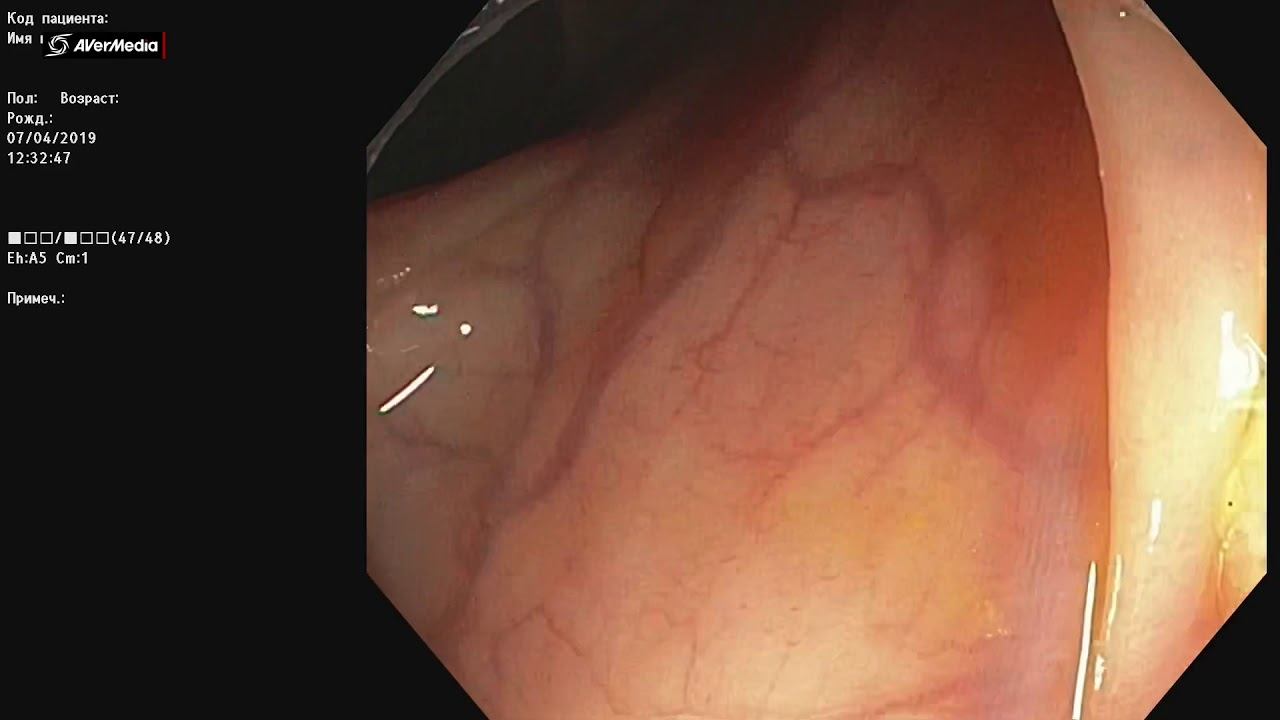 Холодная петлевая резекция зубчатой аденомы/Cold resection SSA смотреть онлайн