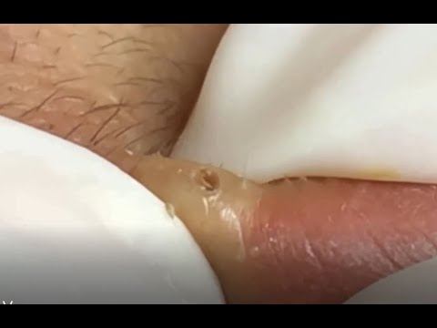 #1 Blackhead Removal \ Удаление черных точек