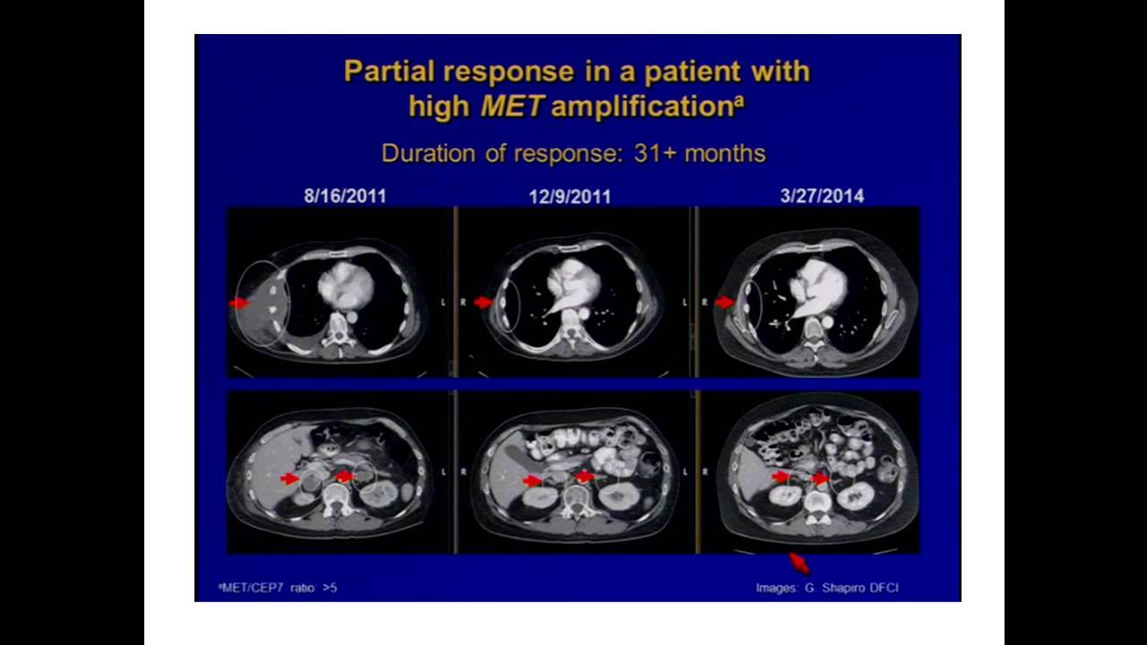 Dr. Renato Martins' talk on Lung Cancer_Binaytara Foundation 2014 смотреть онлайн