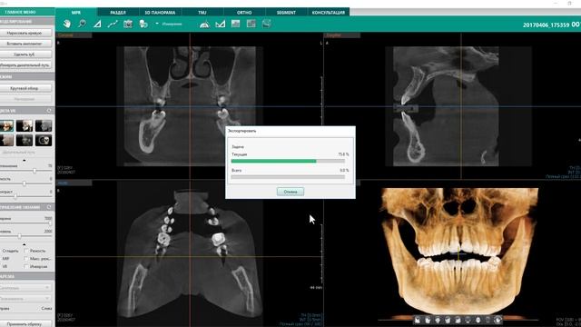 Запись КТ на диск в  программе Ez3D-i