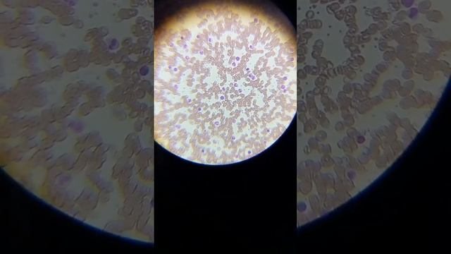 DLC count microscope examination of blood #platelets #RBC #Dlc #dlccount #WBC #sorts #dlc 2023 смотреть онлайн