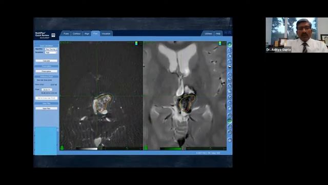 AERO Webinar: Cyberknife Radio surgery for AVM's смотреть онлайн