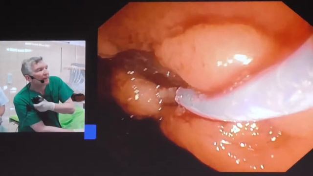 06Live Thomas Rösh Tubular Adenoma of Duodenum piece meal cold snare EMR ERCP смотреть онлайн
