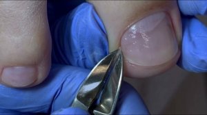 Обработка вросшего ногтя 😰 Никогда не срезайте углы ногтя! Делаем мужской педикюр.