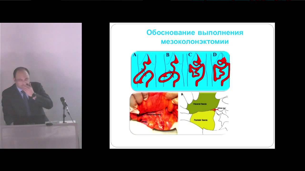 Техника лапароскопической мезоколонэктомии смотреть онлайн