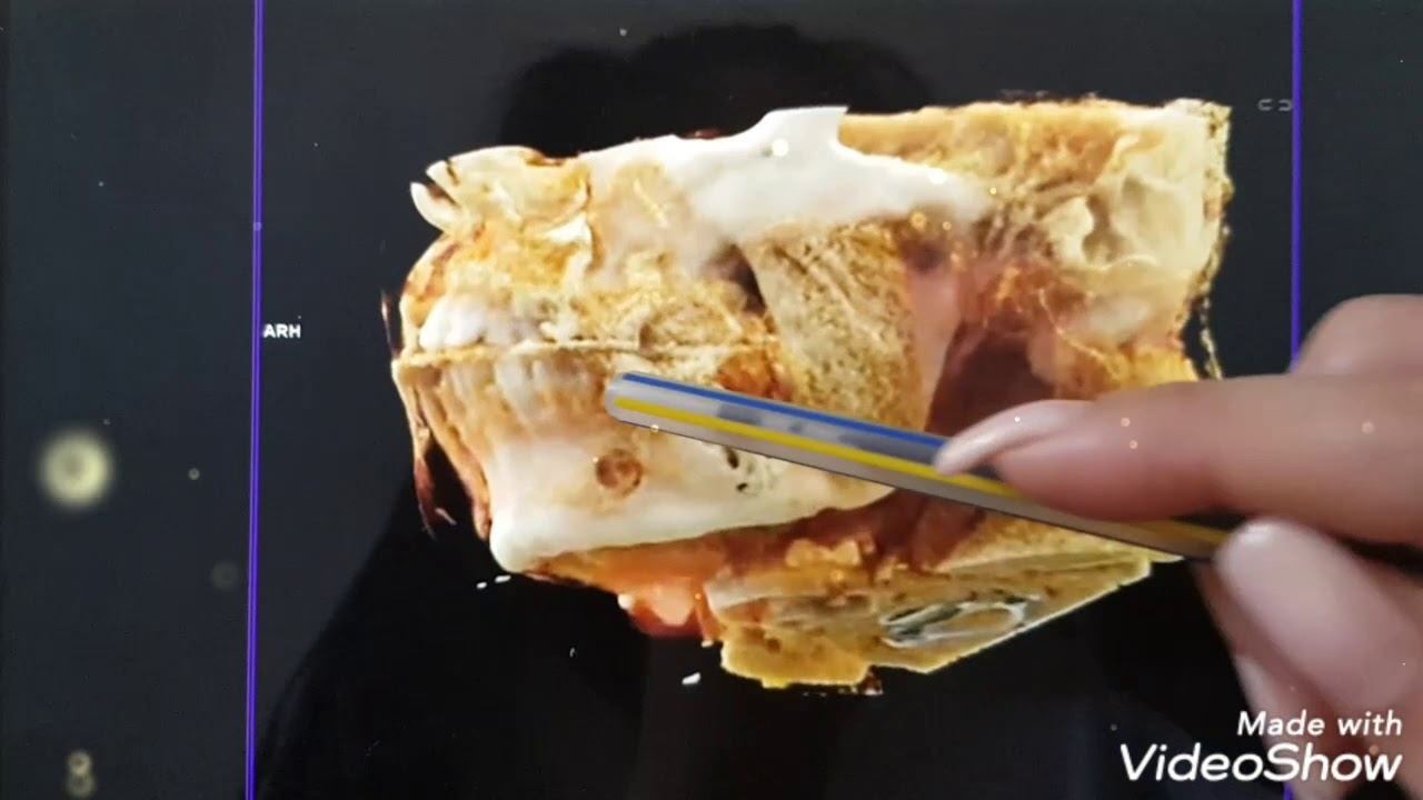 удаление амелобластомы смотреть онлайн