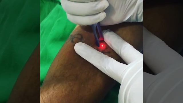 Laser Tattoo removal, Colombo in Sri Lanka смотреть онлайн