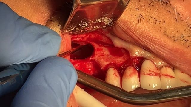 Advanced Dental Procedure: Lateral Sinus Lift with Simultaneous Implant Placement + Online Courses смотреть онлайн
