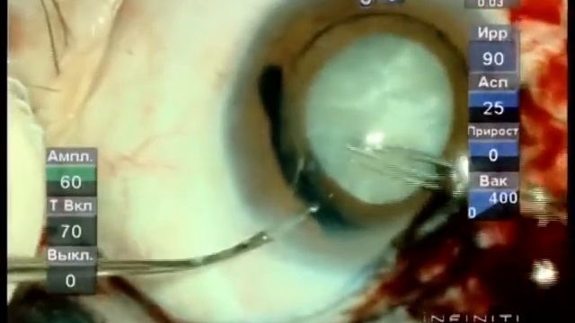 White cataract capsulorhexis with trypan blue смотреть онлайн
