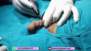 Revision Circumcision Surgery || Dr. Jayanta Bain Plastic and Cosmetic Surgeon