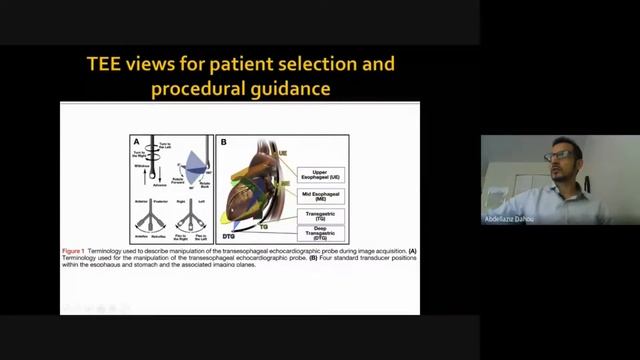Meet The Expert : Tricuspide Valve Part 1 : anatomy & imaging by Dr. Abdellaziz DAHOU смотреть онлайн