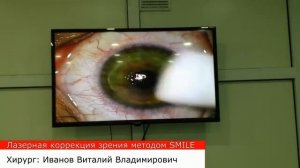 Лазерная коррекция Relex Smile