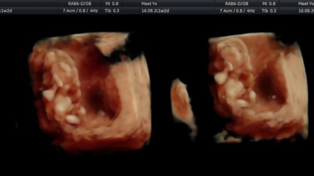 Donor Egg IVF Success - 11 Week Pregnancy Ultrasound смотреть онлайн