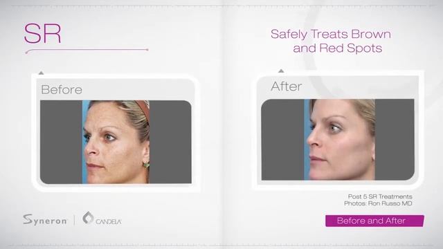 Syneron Candela Laser IPL Advanced available at Sollay Laser Center смотреть онлайн