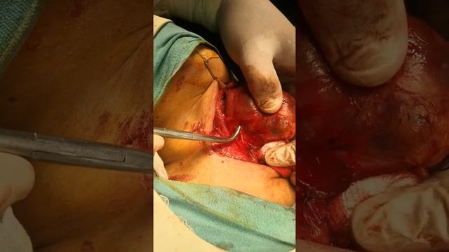 Relationship of inferior thyroid artry and reccuent laryngeal nerve poshto version Dr Hussain sir смотреть онлайн