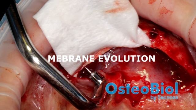 Guided Bone Regeneration AGF смотреть онлайн
