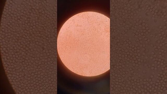 RBC RED BLOOD CELLS LOADED In the Urine sample.. смотреть онлайн