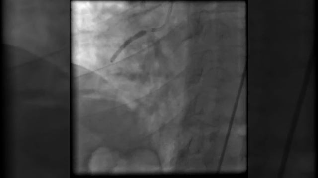 Имплантация стента 3,5 х 31 мм. в проксимальный сегмент ПКА. смотреть онлайн