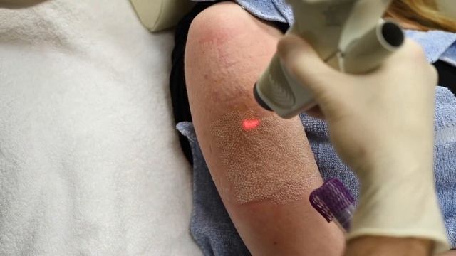 CO2 laser resurfacing with PRP injections for scars at Seiler Skin смотреть онлайн