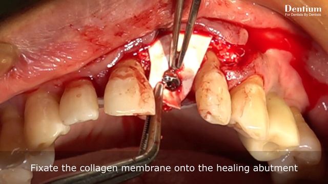 Early Implantation with GBR & CTG Dr. Teddy смотреть онлайн