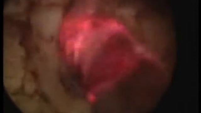 LASER FINGER una nuova fibra per la VAPO RESEZIONE dell'adenoma prostatico смотреть онлайн