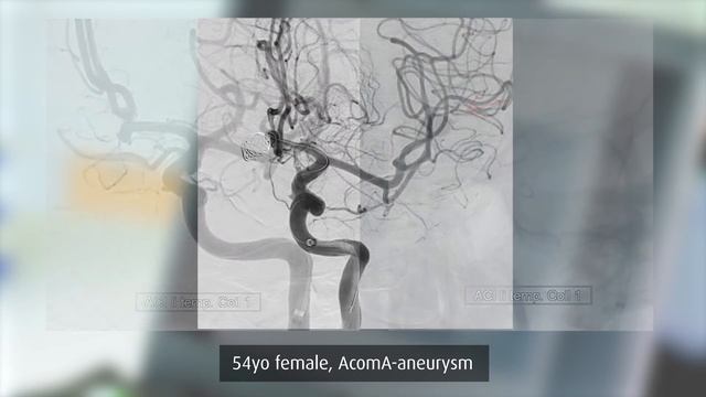 Kaneka Medical Europe N.V. - ED Coil - Prof Rohde смотреть онлайн