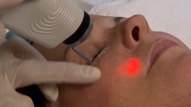 Ultapulse CO2 Laser Treatment Under the Eyes смотреть онлайн