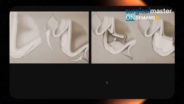 Lateral Sinus Lift Blueprint смотреть онлайн