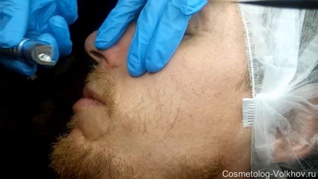 Удаление сосудов лазером смотреть онлайн
