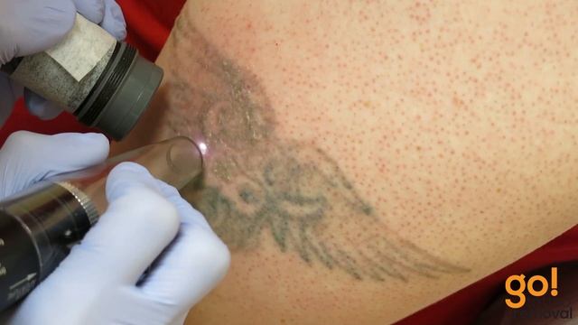 3rd Laser Tattoo Removal Treatment | Go Tattoo Removal, Now Removery смотреть онлайн