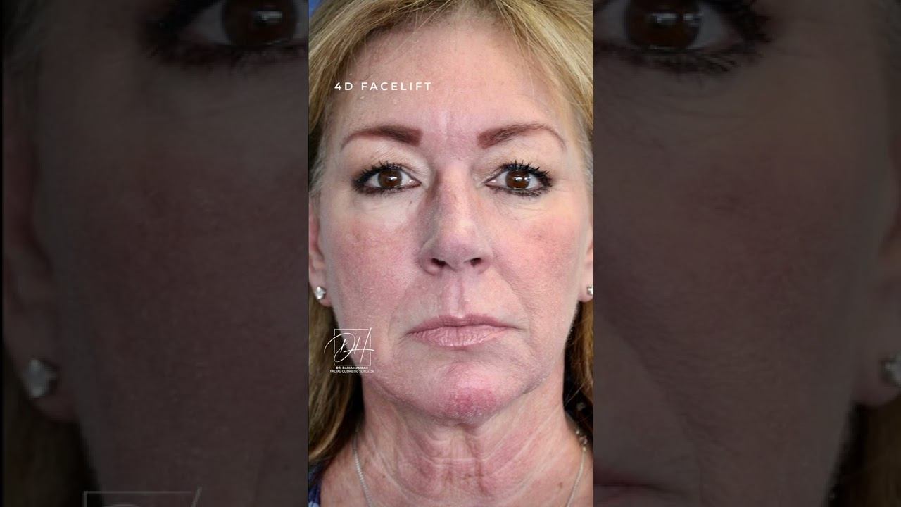 4 D-Facelift procedure #short #facelit #antiaging смотреть онлайн