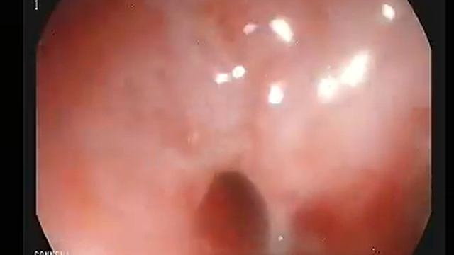Стентирование пищевода (Установка проводника) Endo-Flex смотреть онлайн