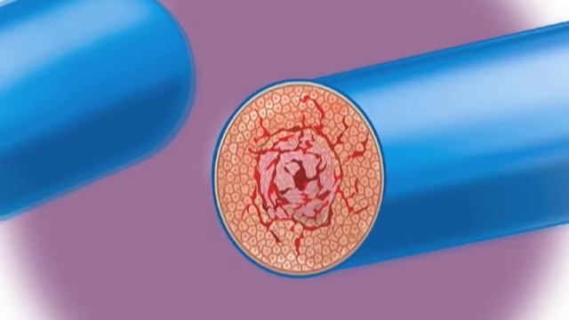 livingwithph.ca - PLEXIFORM LESIONS смотреть онлайн