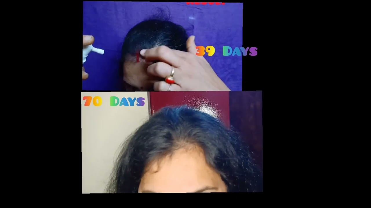 Day 70 Result of Hair Vitamins, Multivitamin, Hair Tonic Serum смотреть онлайн