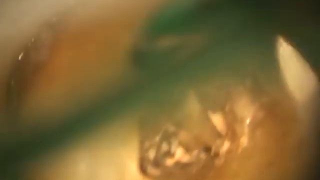 Извление терфамила. Thermafil removal. смотреть онлайн