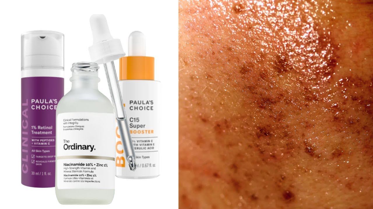 The BEST Skincare for Hyperpigmentation смотреть онлайн