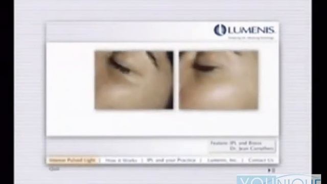 YOUnique Cosmetic Surgery - IPL (Intense Pulse Light) смотреть онлайн