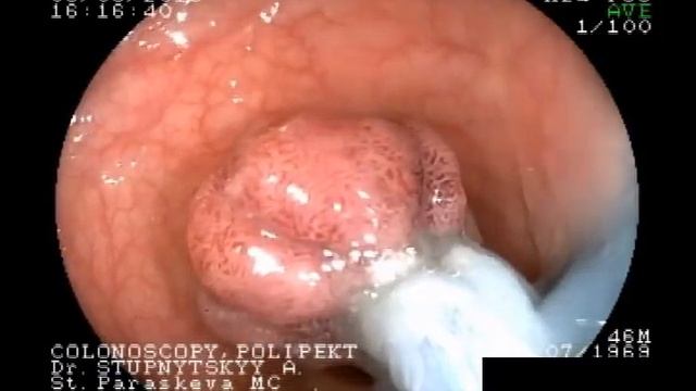 Петлева поліпектомія гарячою петлею двома блоками смотреть онлайн