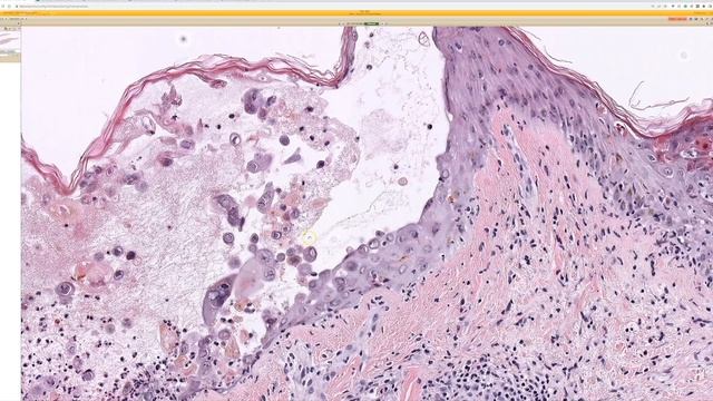 Shingles under the microscope (Varicella Zoster Herpes virus Chickenpox VZV pathology dermatology) смотреть онлайн
