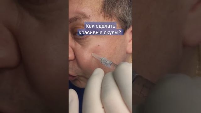 Коррекция скул гиалуроновой кислотой. смотреть онлайн