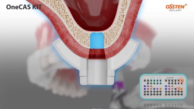 ONECAS KIT - Osstem Implant смотреть онлайн