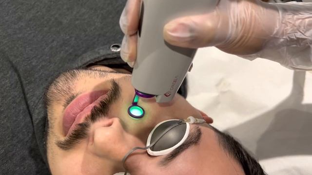 Transforming Skin: VBEAM Laser Treatment Demo for Flawless Results | Real-Time Laser Sound Effects! смотреть онлайн