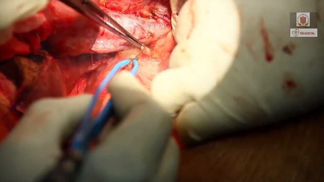 Parenchyma preserving liver resection for type IV A Choledocalcyst with cholangiocarcinoma смотреть онлайн