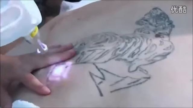 AL1 laser HIMALAYA nd yag смотреть онлайн