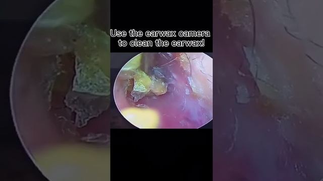 Best Ear Wax Removal & Extraction with Vacuum Remover 真空リムーバーによるにきびの除去と抽出 88 смотреть онлайн