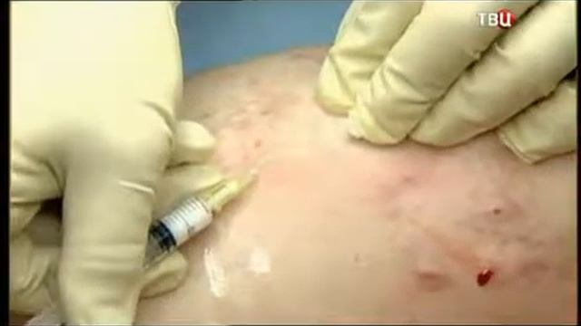 Варикоз Доктор И от 04.03.2015 смотреть онлайн