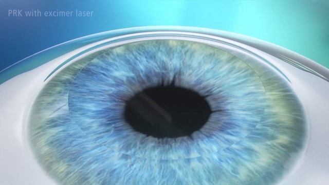 PRK Treatment Animation