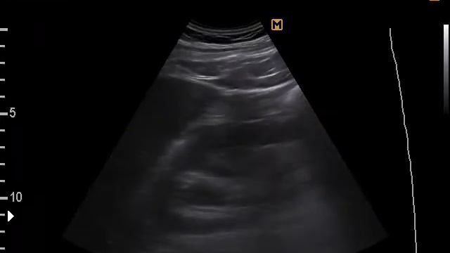 Конкремент средней трети мочеточника (16-5-17) смотреть онлайн