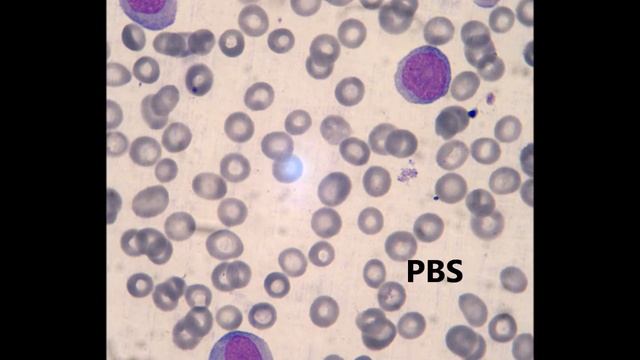 T/ Myeloid Acute Leukemia смотреть онлайн