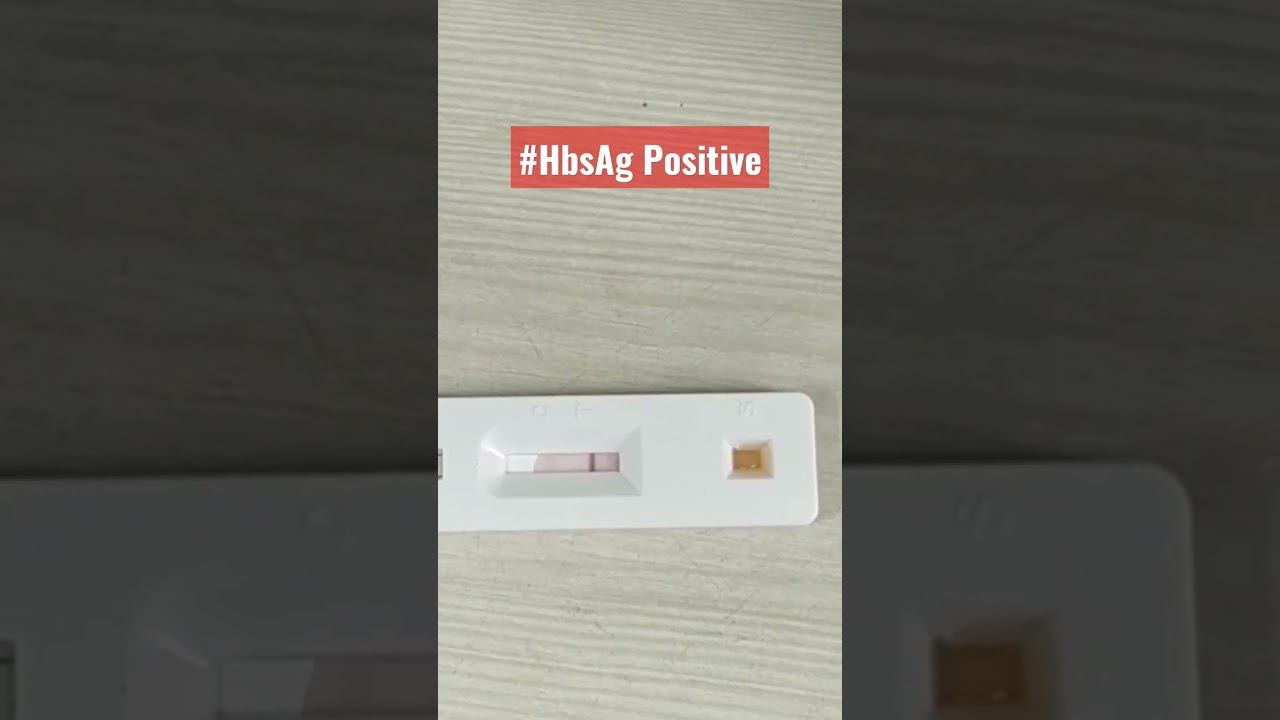 #HbsAg test #hbsag positive #lab смотреть онлайн